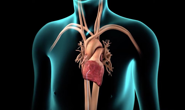 Phương pháp đốt điện tim được sử dụng phổ biến trong điều trị rối loạn nhịp tim